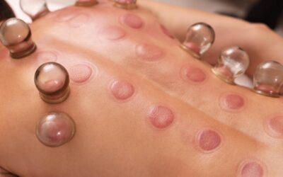Those Purple Circles Aren’t Bruises (What Cupping Really Does)