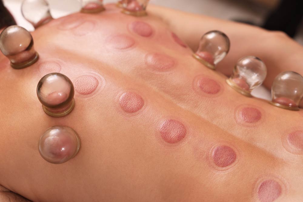 Patient's back with many glass suction cups and purple circles on the skin