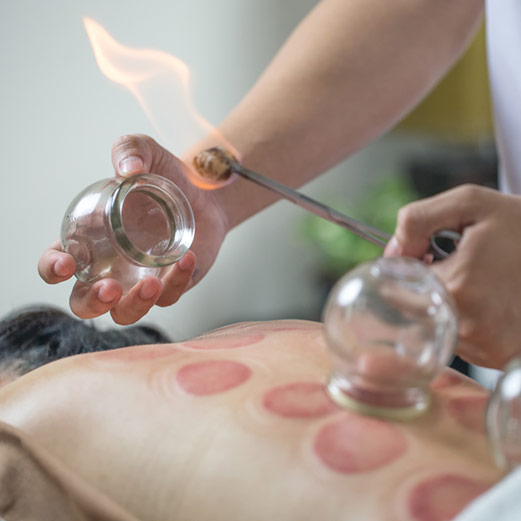 Cupping & Gua Sha